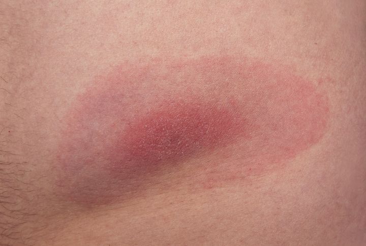 Piq re De Tique Caract ristiques Pathologies Traitements Elsan
